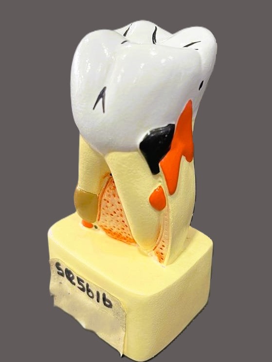 Diseased Tooth Model A540